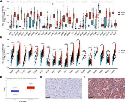 KIF2C is a Biomarker Correlated With Prognosis and Immunosuppressive Microenvironment in Human Tumors